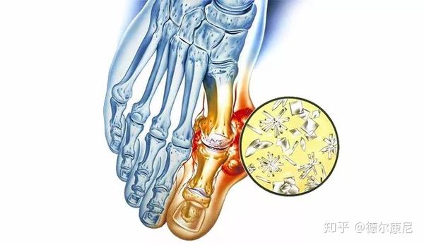痛风性关节炎多发生在足部关节,第一跖趾关节,也就是大脚趾的关节.
