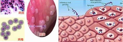尖锐湿疣为何总是反复发作?