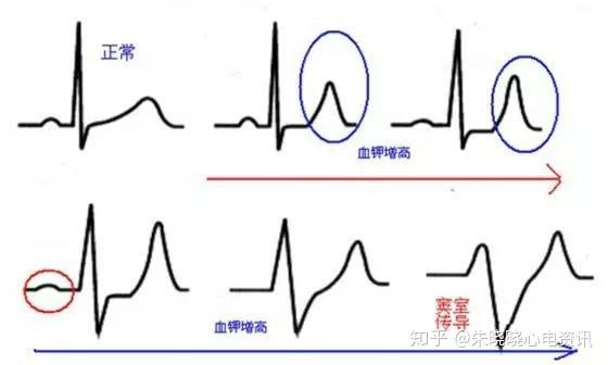 电解质紊乱与心电图