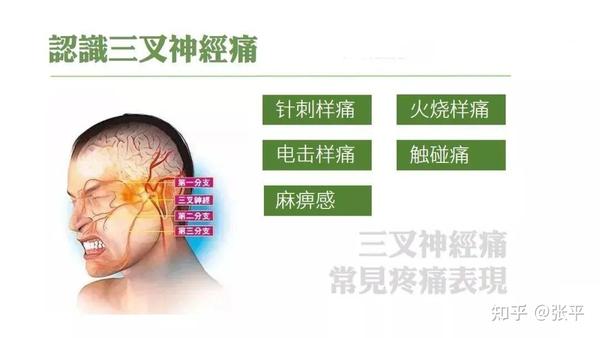 不开刀一根针治疗三叉神经痛