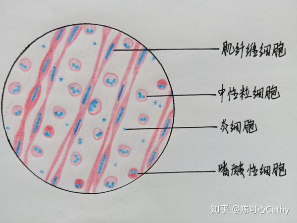发完就清相册啦~ 有不妥的地方还希望大家指正  一,肝细胞水肿 最后