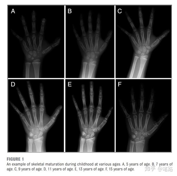 孩子骨骼成熟度:幼儿小手的 x 射线 原来是这样的