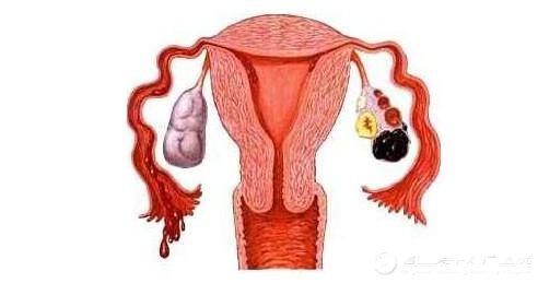 宫颈囊肿会使宫颈口阻塞影响精子进入,严重时会导致不孕.