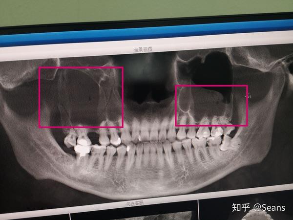 拔牙引起上颌窦穿孔是什么体验