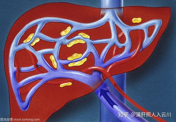门静脉高压是怎么行成的?该如何治疗