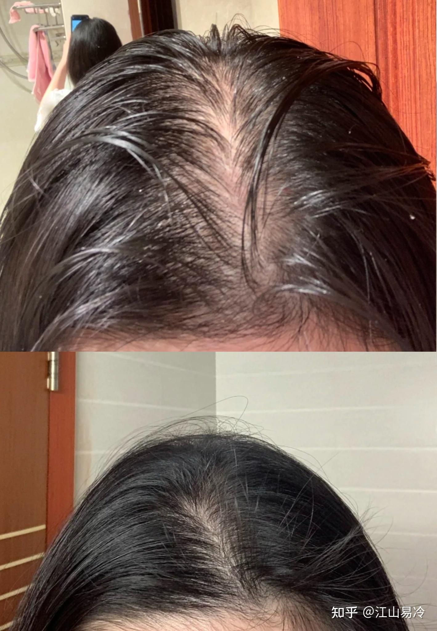 脂溢性脱发还能长吗