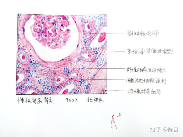 19.乳腺纤维腺瘤