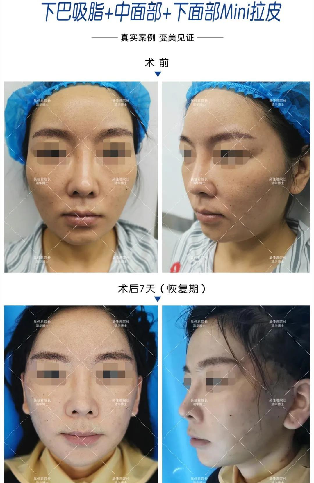 做完迷你拉皮7天可以大变样