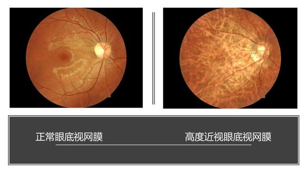 如果近视度数越高,眼球的容积就会越膨胀,相应视网膜也就会越来变薄