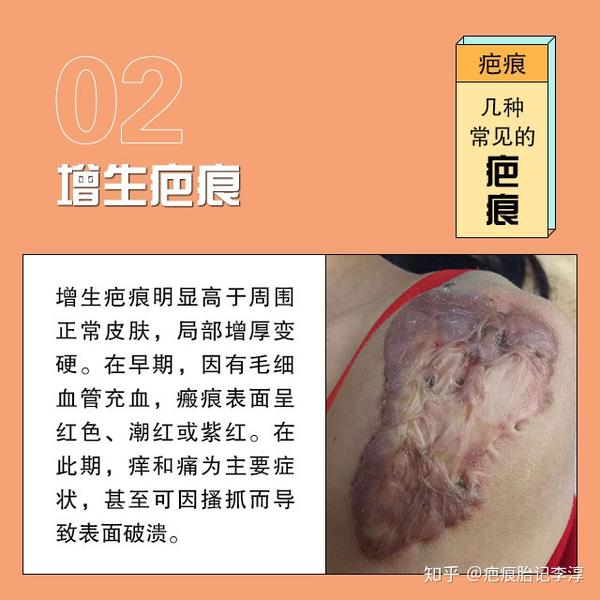 凹陷疤痕:凹陷疤痕是由于外伤导致皮肤真皮层及皮下组织缺损,而在