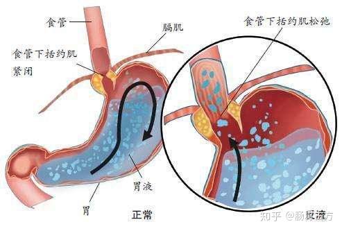 科普胆汁反流性胃炎和胃食管反流的区别有哪些