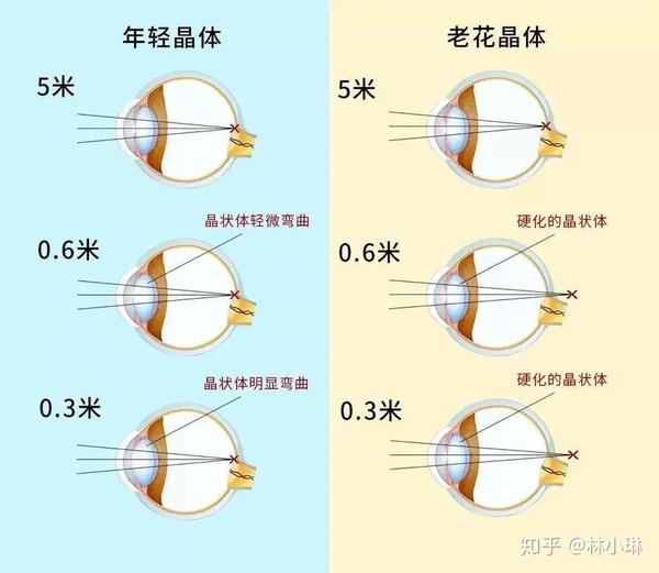科普时间: 老花眼 ≠ 远视眼
