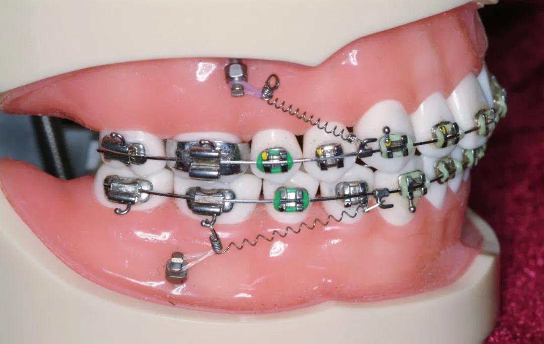 牙齿矫正骨钉和附件有什么区别