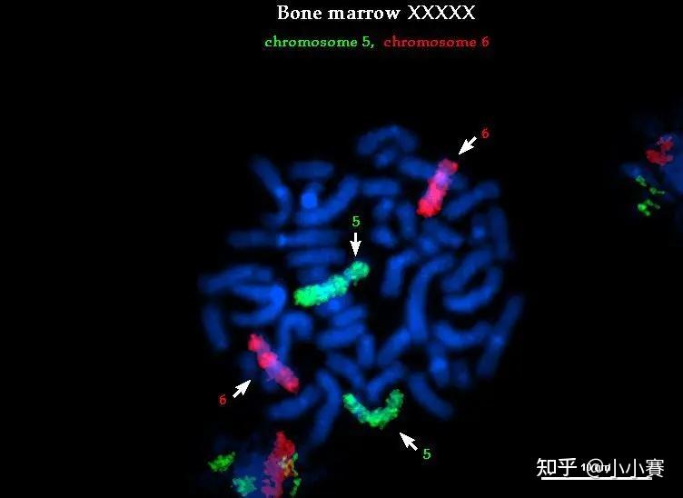 5号(绿色)和6号(红色)染色体荧光原位杂交乳腺癌her2基因扩增检测