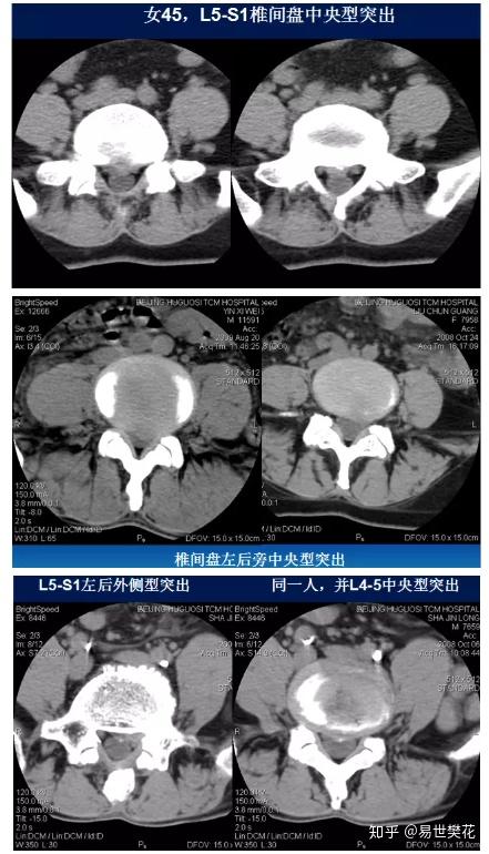 椎间盘膨出,突出,侧隐窝狭窄( ≤2mm),黄韧带肥厚(>5mm),后纵韧带骨化