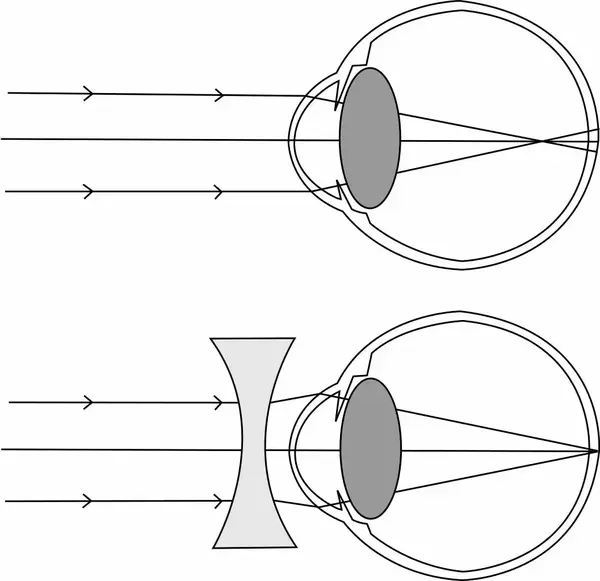 而利用凹透镜能使光发散的特点,则能使成象往后移至视网膜上,使成像