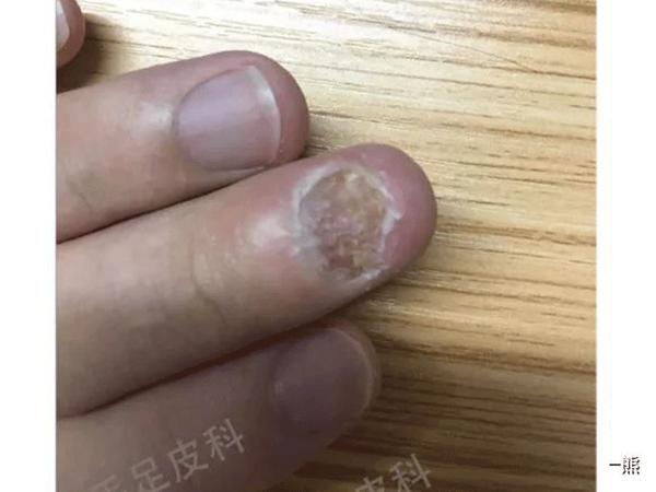 灰指甲手指中指坏甲破茧重生之旅