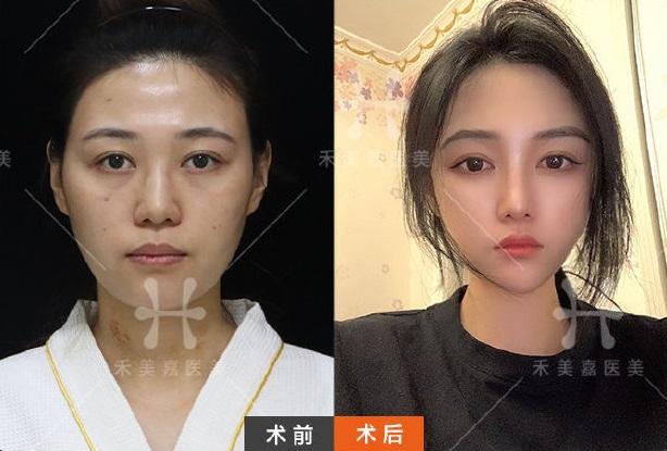 面部吸脂有效果吗