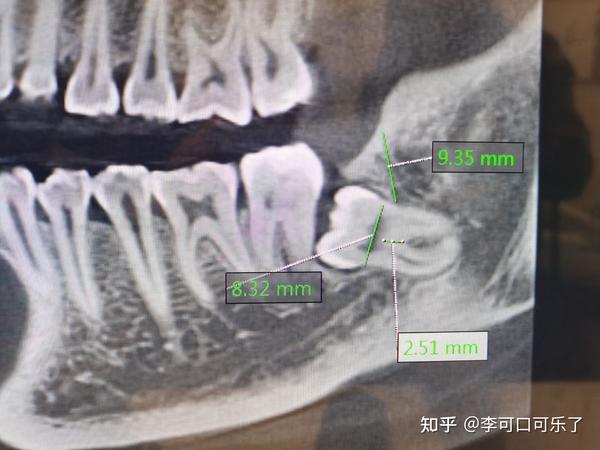 低位全埋伏阻生智齿