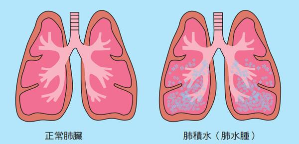 唐跃良 肺部手术后出现胸腔积液怎么办?