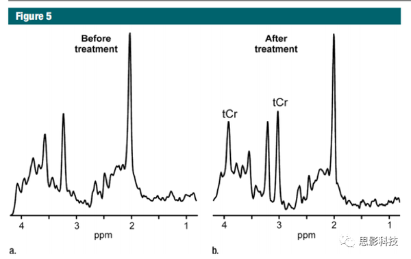 radiology:质子磁共振波谱分析在中枢神经系统疾病中的应用