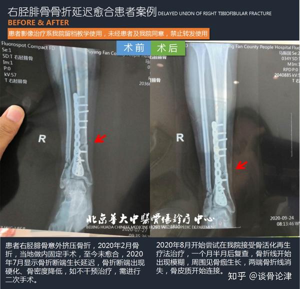 右胫腓骨骨折延迟愈合治疗案例及胫腓骨骨折康复指导