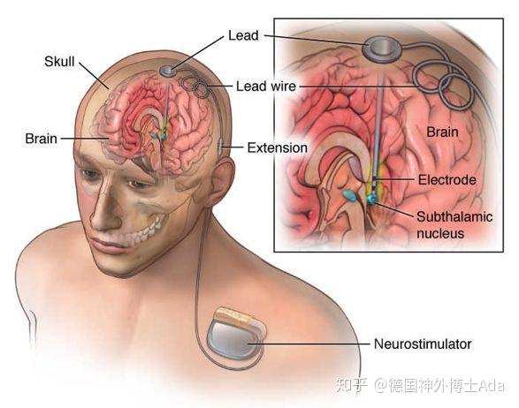 dbs,俗称"脑起搏器",来源网络