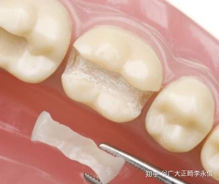 氟斑釉质牙,死髓变色牙,釉质发育不良牙; ③前牙形态异常,如