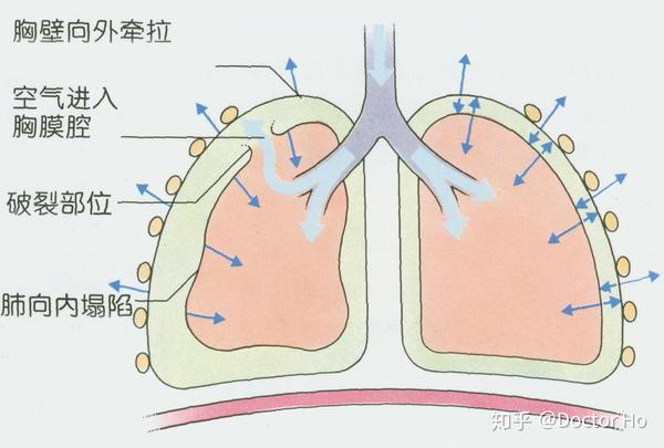 胸膜摩擦音(胸水少时) 定   义:胸膜腔为脏层