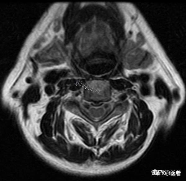 典型病例——颈椎后纵韧带钙化(mr)