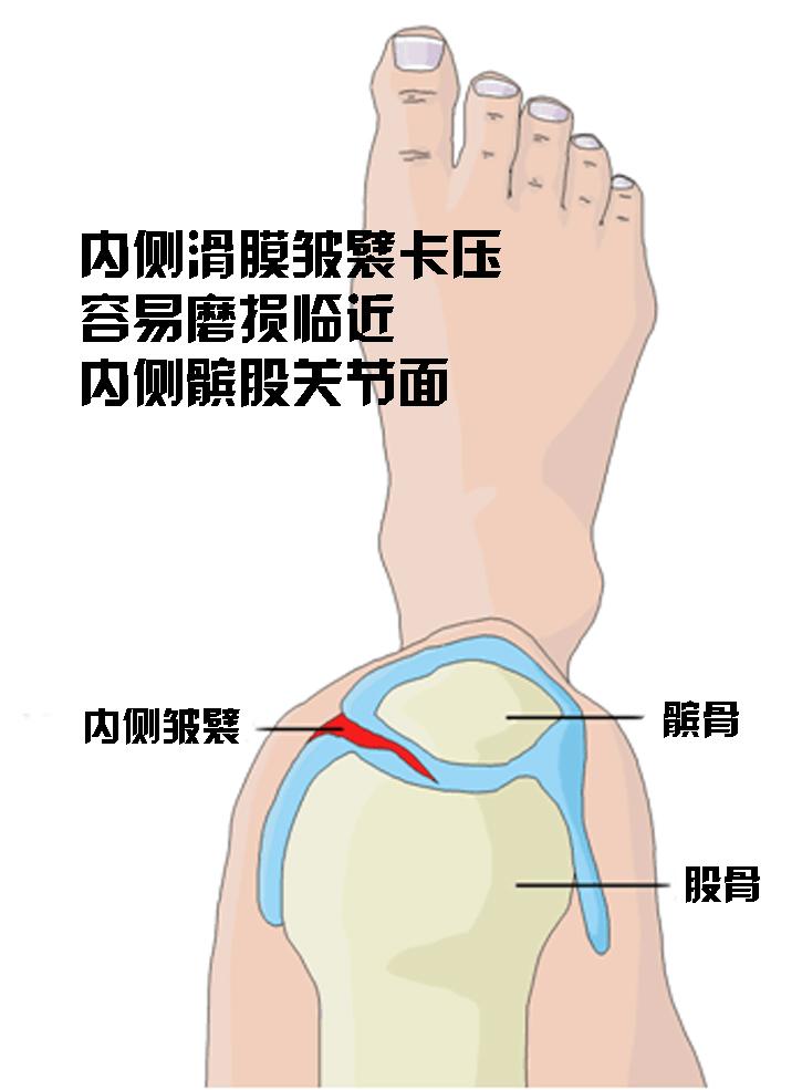 膝关节里那磨人的小妖精:滑膜皱襞(plica)综合症