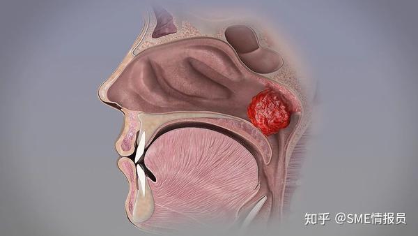 当腺样体增大到一定程度时,就会堵住鼻孔,使鼻子塞住