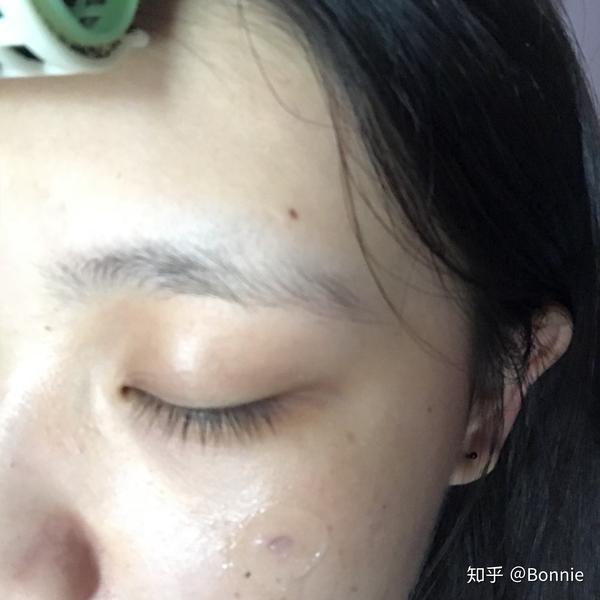 激光点痣后吃什么比较好恢复?