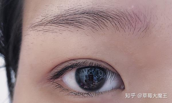 重度倒睫毛手术的全过程分享