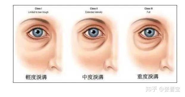 眼袋重泪沟轻,只做眼袋90%会出现这个问题!