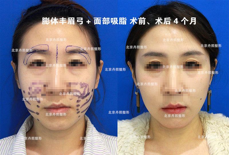 假体丰眉弓联合下面部吸脂塑形案例