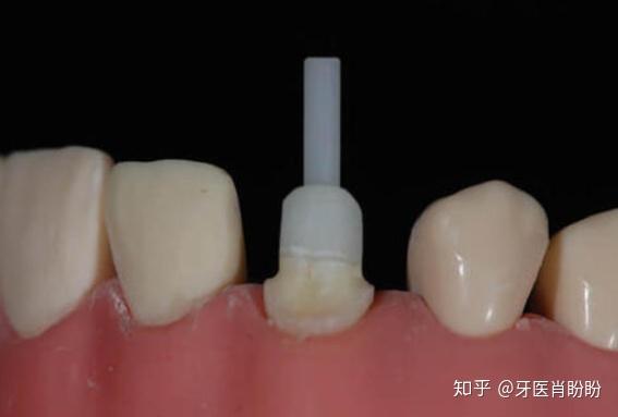 适用于牙根过短,难以进行桩冠修复的患者.