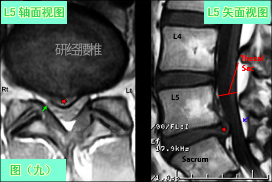 在轴状面及矢状面图(蓝箭头与红五星之间)可观察到硬膜囊有来自这个