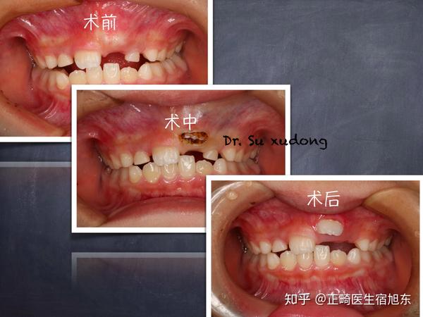 多生牙导致恒牙萌出受阻