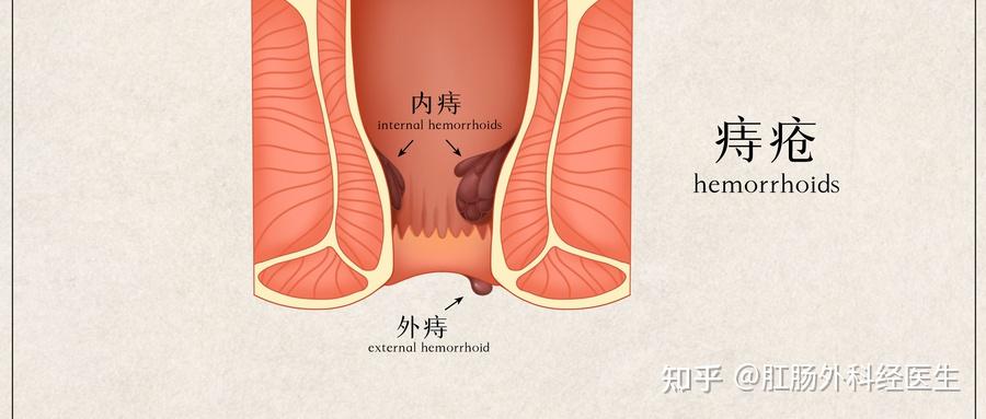 痔疮会痛到怀疑人生这是真的吗