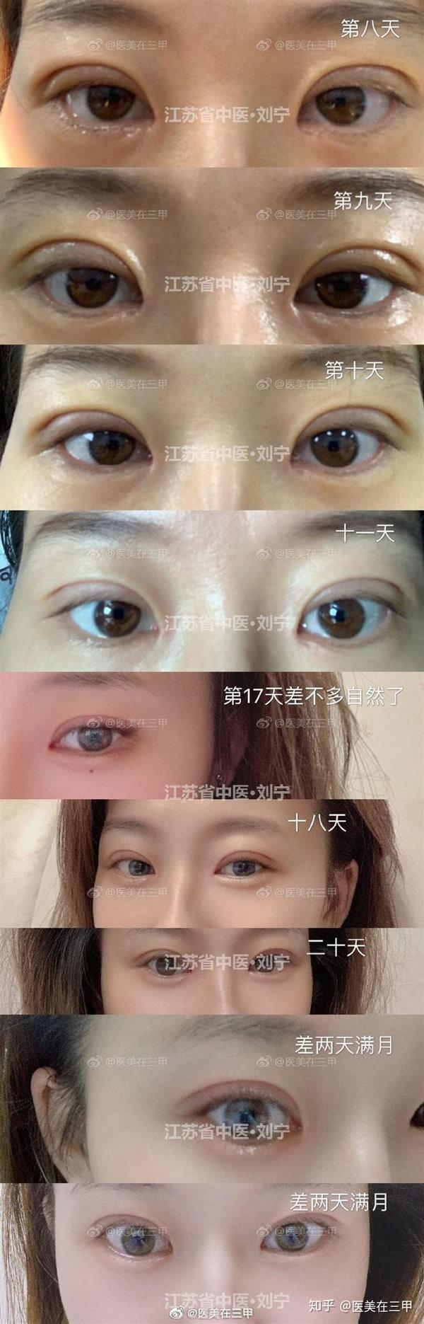 单眼皮变成双眼皮,真的好看吗?