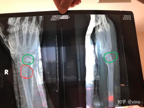 手腕月骨坏死手术记录更新一年后