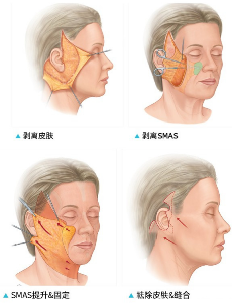 自体脂肪填充和小切口拉皮手术一起做冲突吗