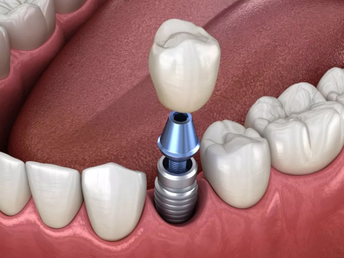 口腔临床医学博士 1,牙龈组织穿孔:在种植体植入的愈合阶段,可能会