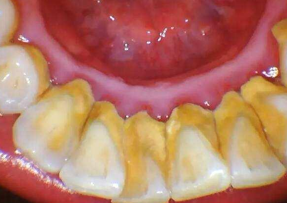 牙龈下厚厚一层污垢是什么不洗牙永远都不知道牙齿有多脏