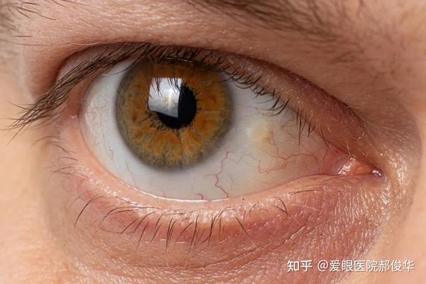 睑裂斑,是眼科常见的良性疾病,是由于暴露在外界的睑裂区鼻侧,颞侧