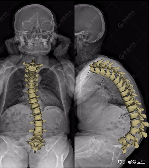 【高尚病例】}eos协同ct对强直性脊柱炎并脊柱侧弯畸形的影像评估