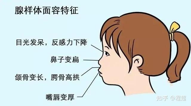 02,腺样体和扁桃体肥大为什么会导致儿童张口呼吸?