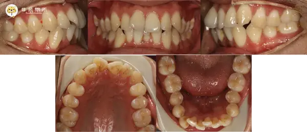 【正畸病例】牙突,嘴突,拔4个4病例一例