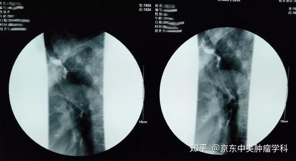 食道里置入金属覆膜支架,八旬老人终于能安心吃饭了